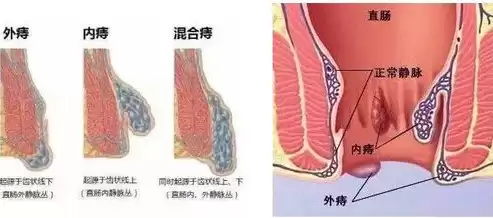 什么叫做混合痔疮，什么叫做混合