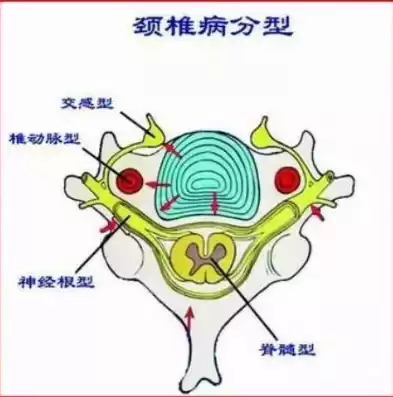 什么叫做混合型颈椎病，什么叫做混合