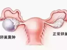 什么是卵巢混合型结构，卵巢混合结构是什么意思