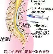 椎管内麻醉并发症的处理，椎管内麻醉并发症及处理原则有哪些