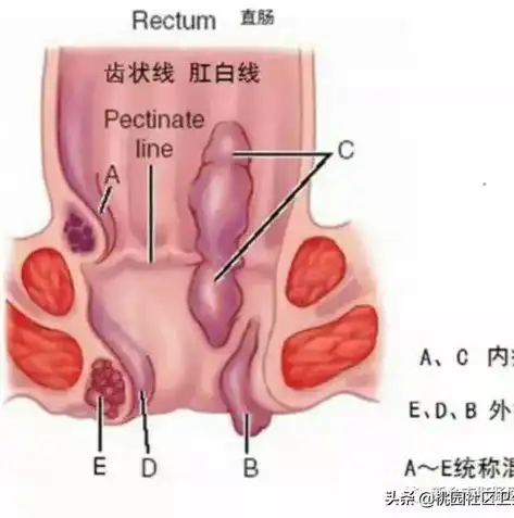 混合痔疮怎么治疗最好方法 男性，男性混合痔疮治疗攻略，探寻最佳治疗方案，告别不适困扰