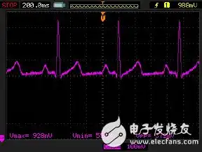 心电监护的并发症及处理措施视频，心电监护并发症及应对策略解析