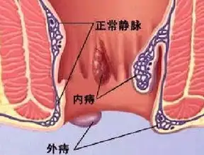 混合痔疮怎么治疗最好方法 女性，女性混合痔疮治疗攻略，揭秘最佳治疗方案