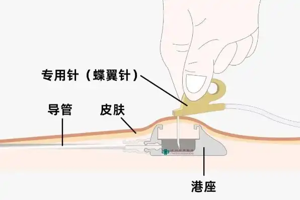 输液港的并发症及处理方法，输液港并发症的识别与应对策略