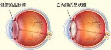 白内障手术术中及术后并发症处理指南，白内障手术并发症预防与处理临床指南详解