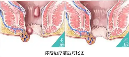 混合痔疮怎么治疗最好方法 男性，男性混合痔疮的攻克之道，揭秘最佳治疗方法