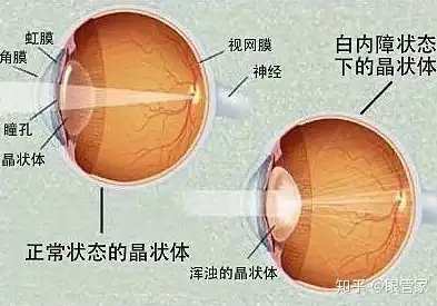 白内障手术并发症全程管理策略与实践指南，白内障手术术中及术后并发症处理指南最新